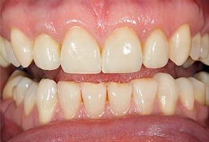 The image displays a close-up view of an individual s teeth with noticeable staining, particularly on the front teeth, which appear yellowed and discolored.