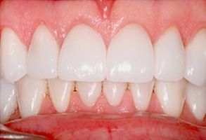 The image shows a close-up of a person s teeth with a focus on a dental implant, highlighting its color and texture contrast against the surrounding natural teeth.